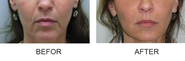 3injectable-fillers-pereoral_befor-after