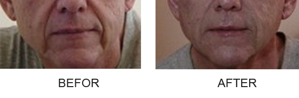 injectable-fillers-nasolabial_fold_before_after