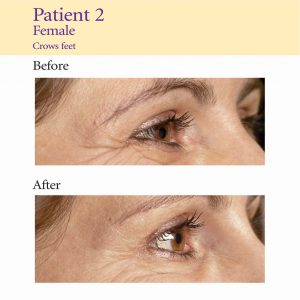 anti-wrinkle injections-patient2